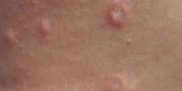 Гнойничковые заболевания кожи (пиодермия): диагностика и лечение
